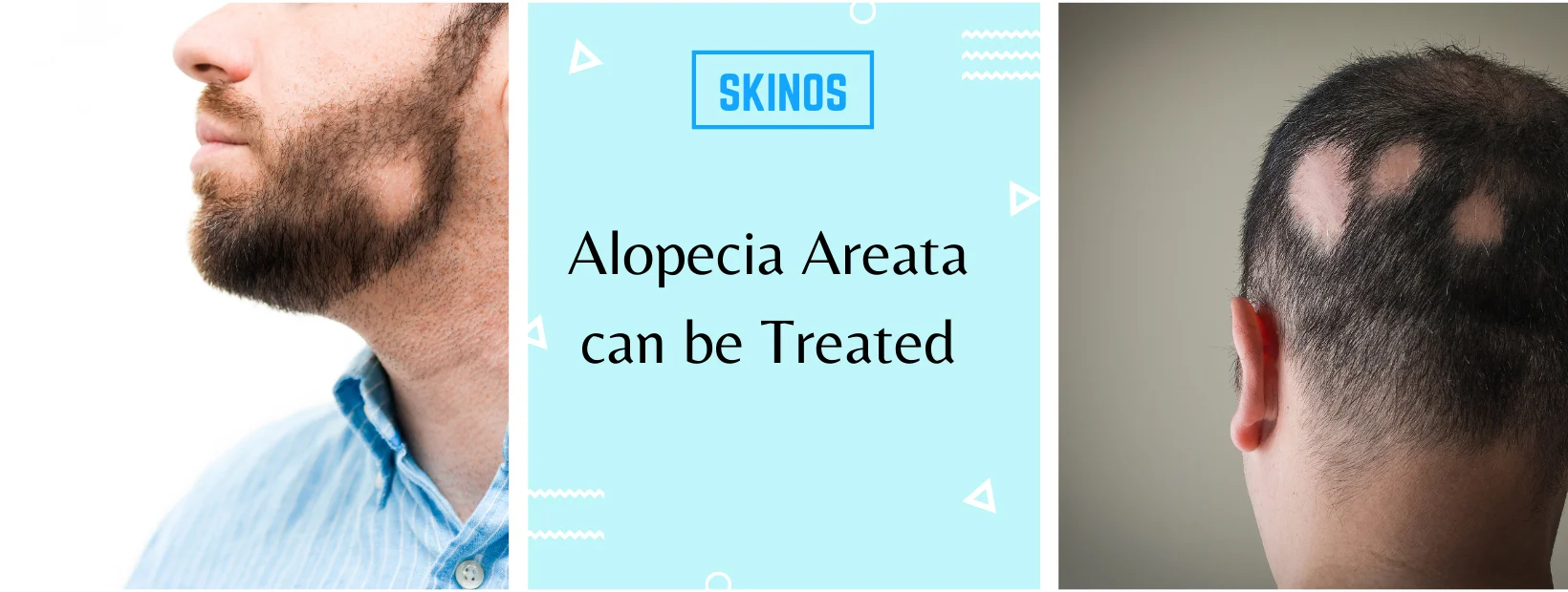 alopecia areata treatment in delhi
