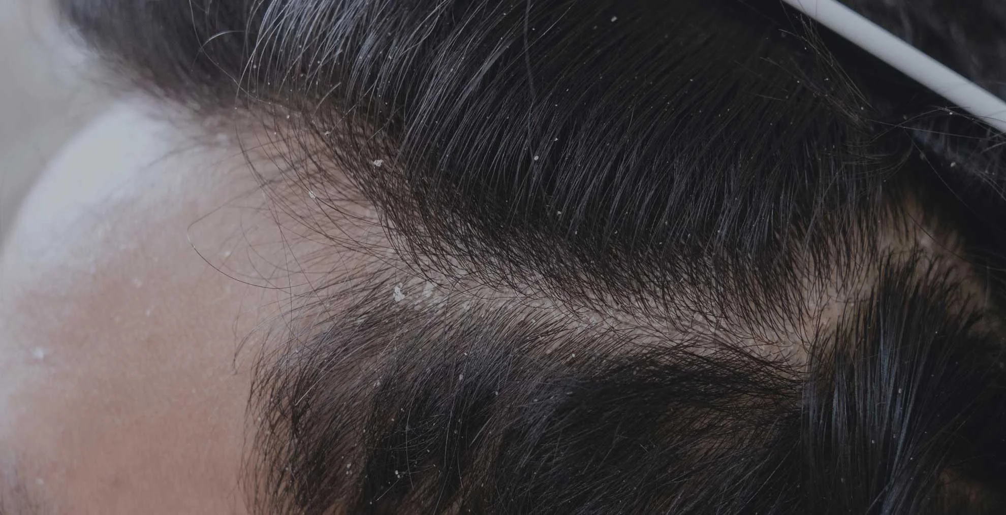dandruff treatment in delhi