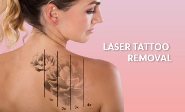 Permamant Laser Tattoo Removal Clinic in Gurgaon  Treatment Cost