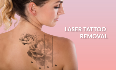 Tattoo Removal Prices In Sydney  Clean Canvas Laser Clinic