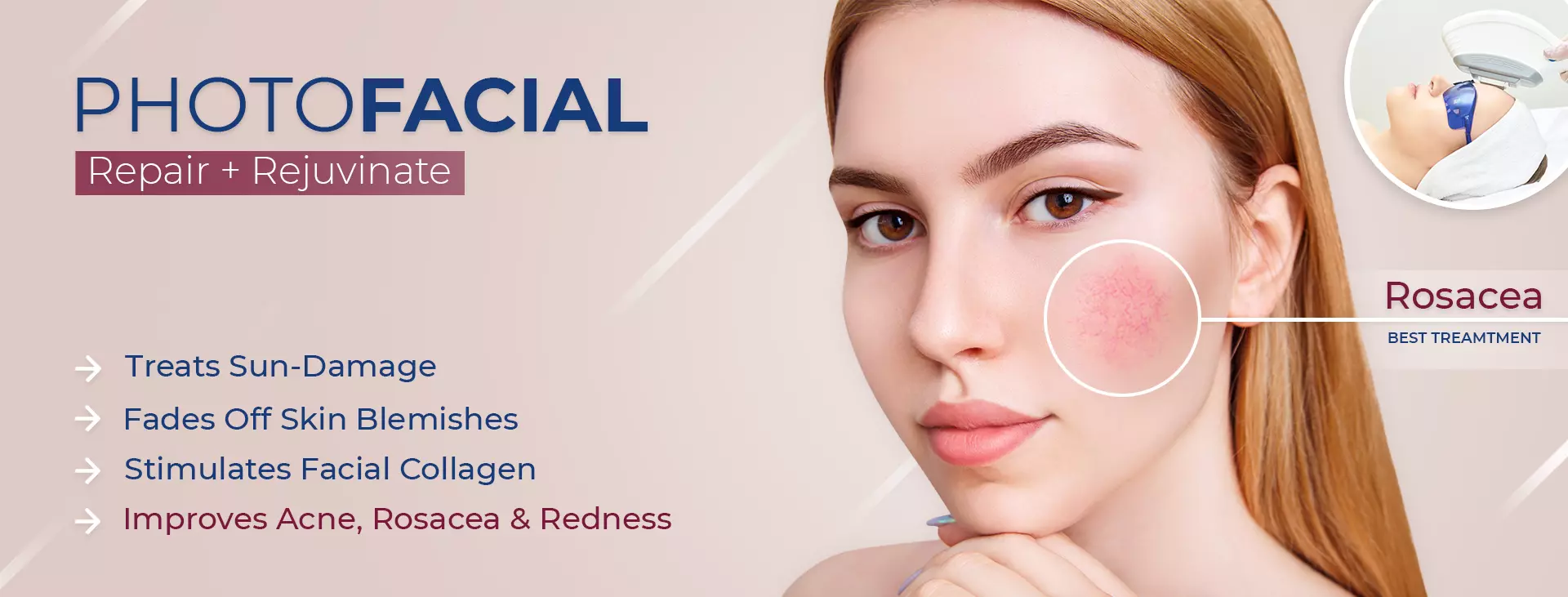 photofacial in delhi