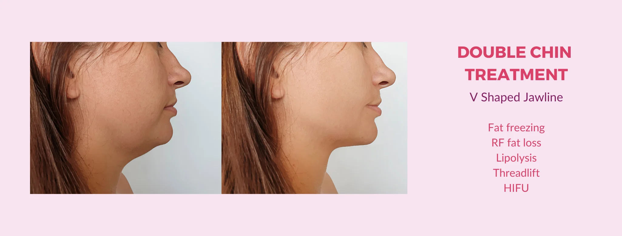 double chin treatment in delhi