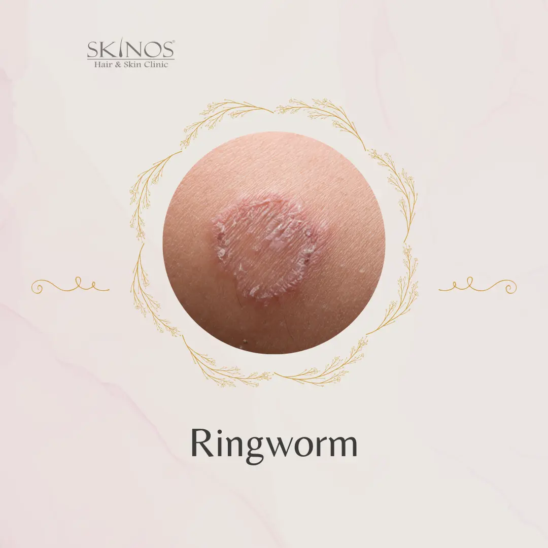 Ringworm