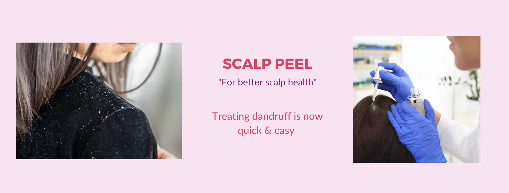 scalp peel treatment in delhi