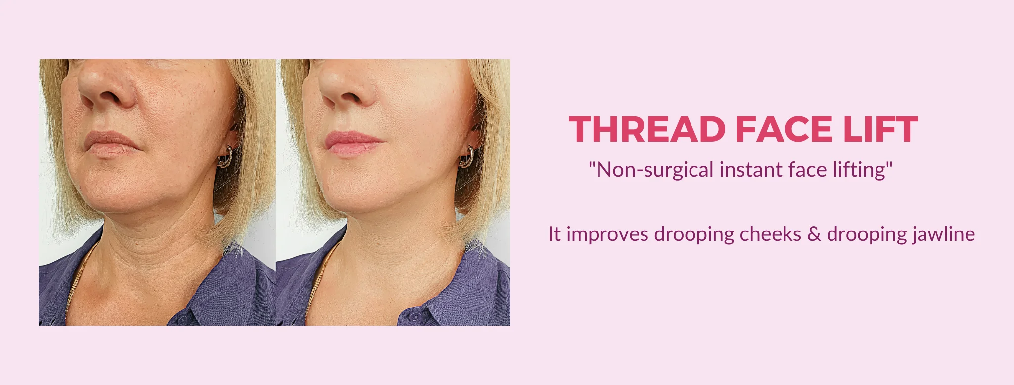 thread lift treatment in delhi