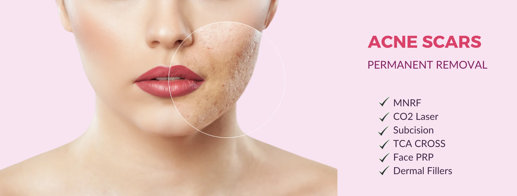 acne scar removal in delhi