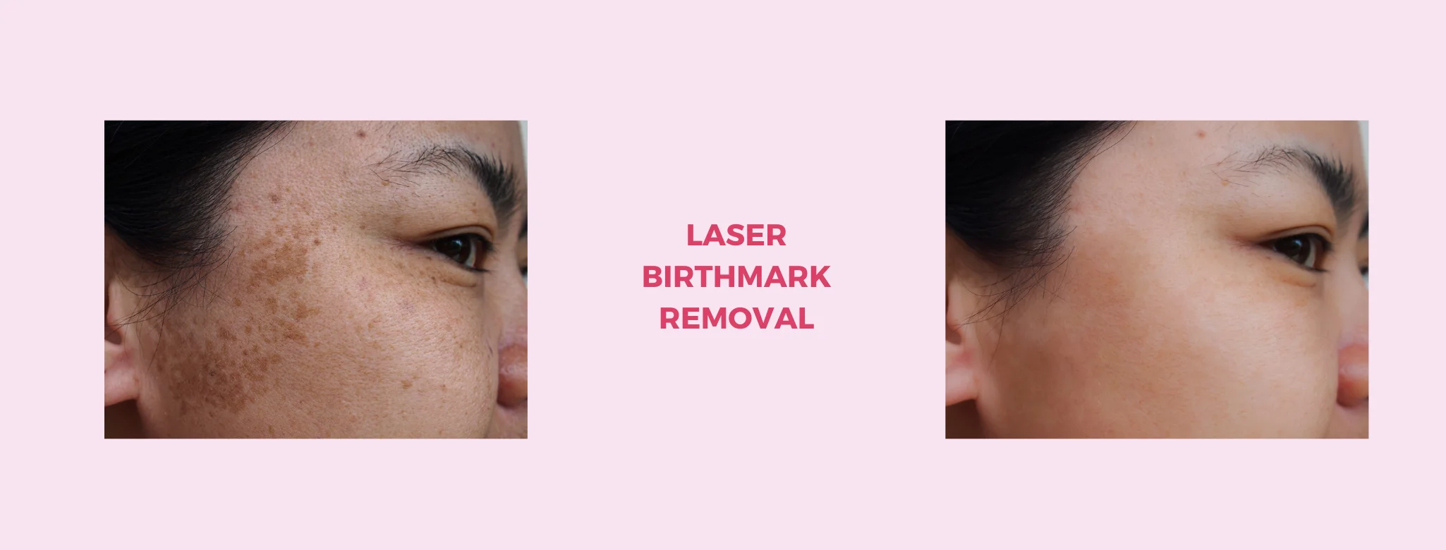 birth mark removal in delhi