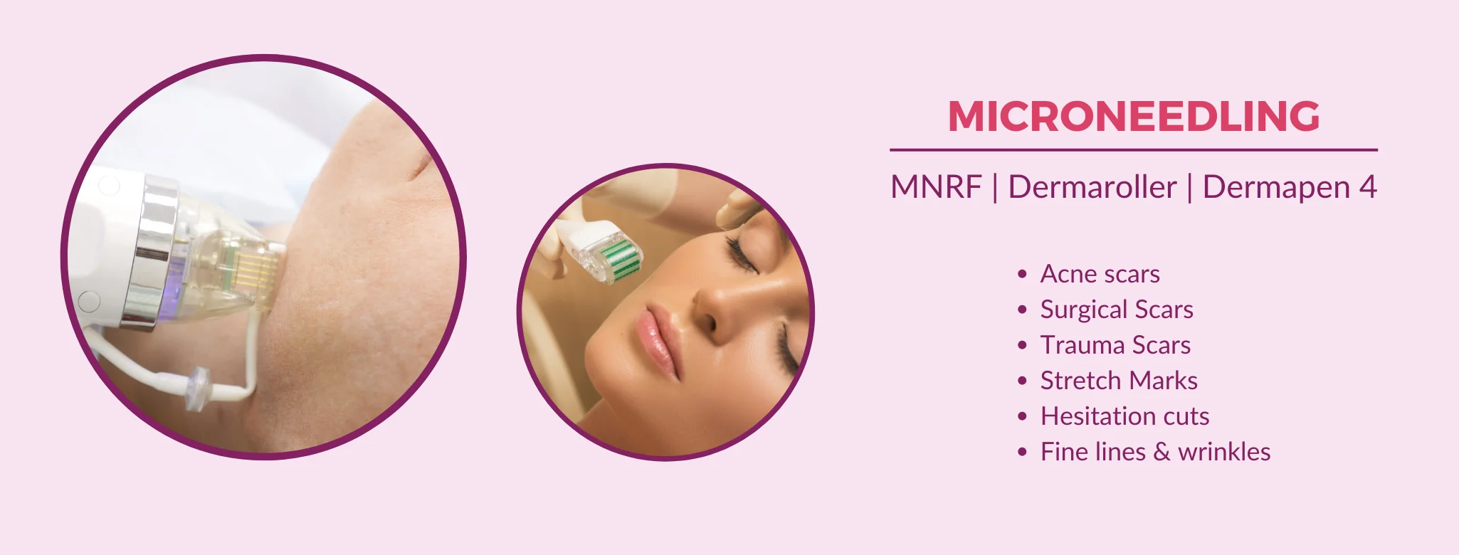 open pores treatment in delhi