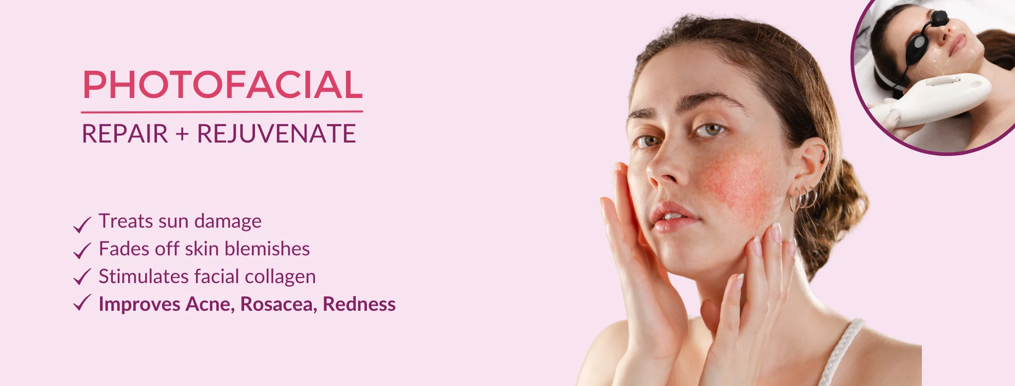 photofacial in delhi