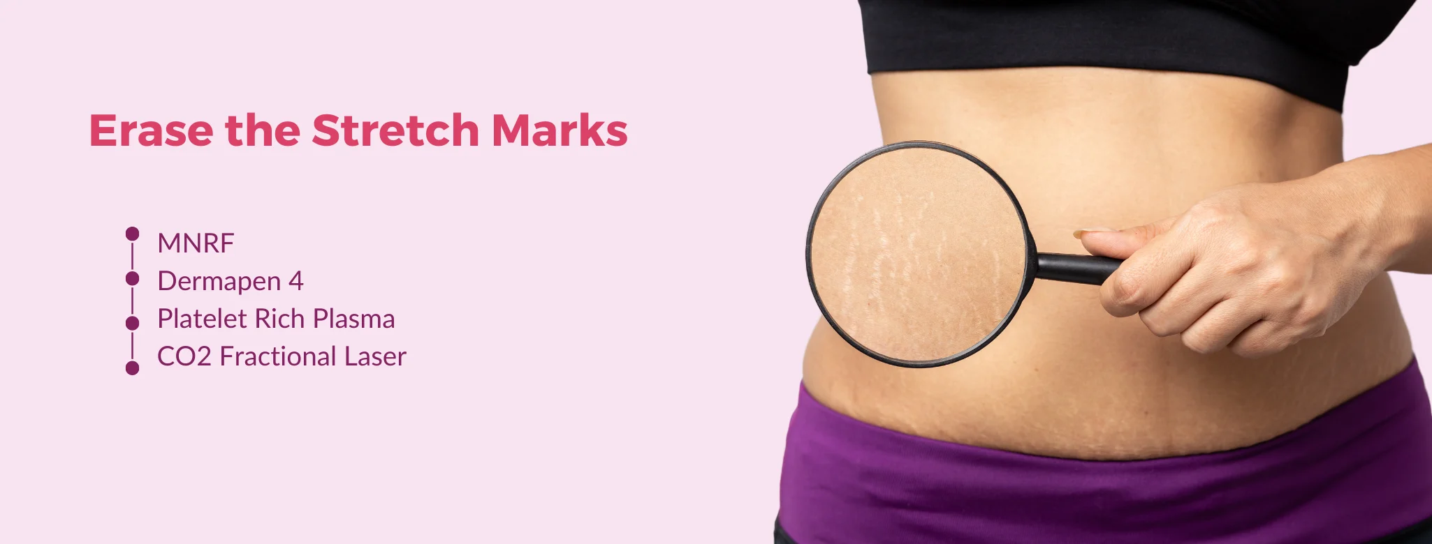 streatch mark removal in delhi